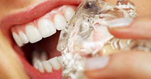 DikoDent Fogászat | A fogakat romboló 9 rossz szokásunk