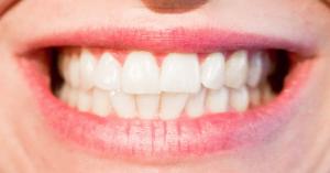 DikoDent | Fluoridokkal a fogszuvasodás ellen